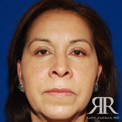 Browlift Before & After Gallery - Patient 296243 - Image 2