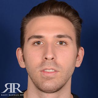 Chin Augmentation Before & After Gallery - Patient 361159 - Image 2