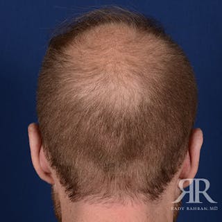 Ear Pinning Surgery Before & After Gallery - Patient 264744 - Image 8