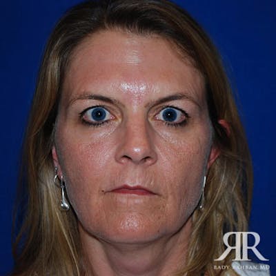 Facelift Before & After Gallery - Patient 139076 - Image 1