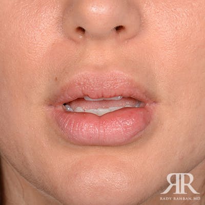 Lip Reduction / Lip Correction Before & After Gallery - Patient 204159 - Image 1