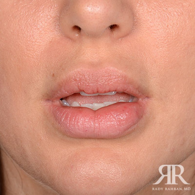 Lip Reduction / Lip Correction Before & After Gallery - Patient 204159 - Image 1