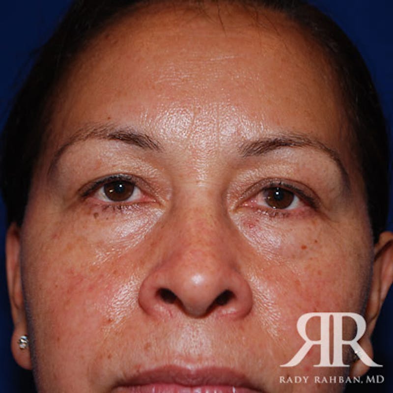 Browlift Before & After Gallery - Patient 296243 - Image 3