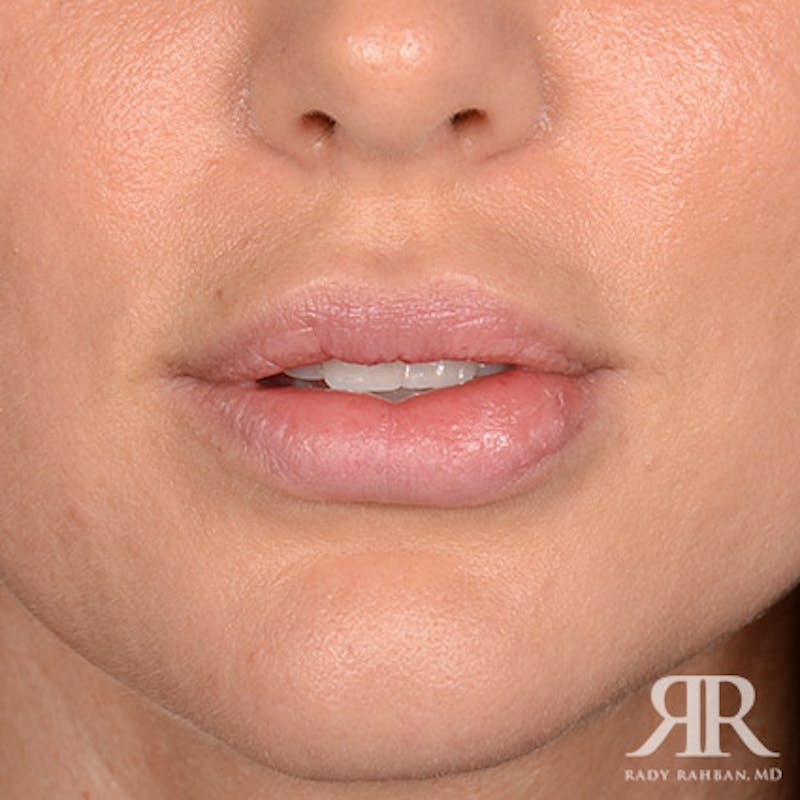 Lip Reduction / Lip Correction Before & After Gallery - Patient 204159 - Image 2