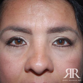 Eyelid Surgery Before & After Gallery - Patient 228793 - Image 2