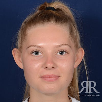 Ear Pinning Surgery Before & After Gallery - Patient 429091 - Image 1