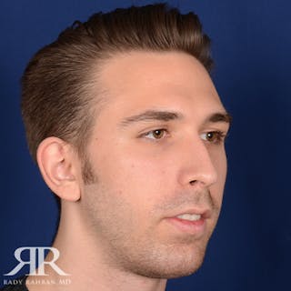Chin Augmentation Before & After Gallery - Patient 361159 - Image 4