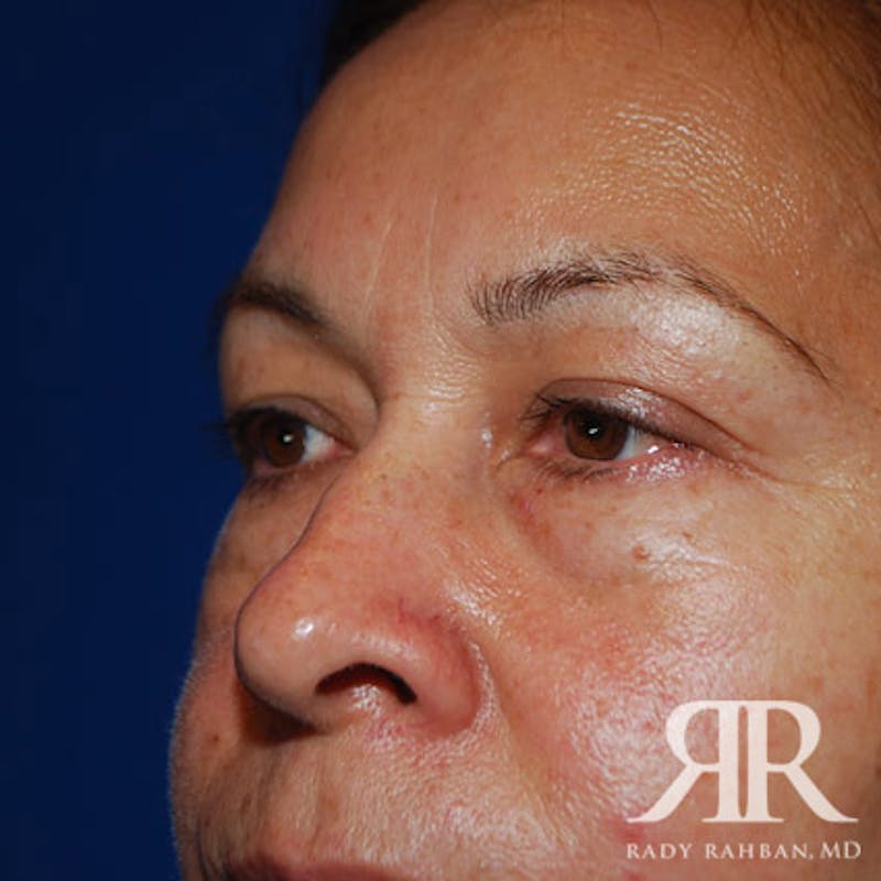 Browlift Before & After Gallery - Patient 296243 - Image 5