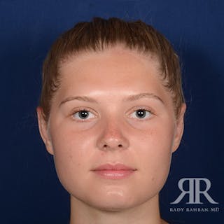 Ear Pinning Surgery Before & After Gallery - Patient 429091 - Image 2