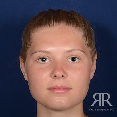 Ear Pinning Surgery Before & After Gallery - Patient 429091 - Image 2