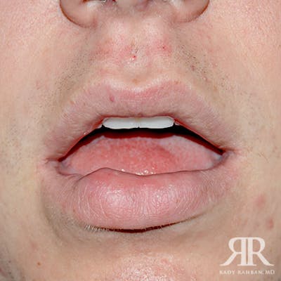 Lip Reduction / Lip Correction Before & After Gallery - Patient 784105 - Image 1