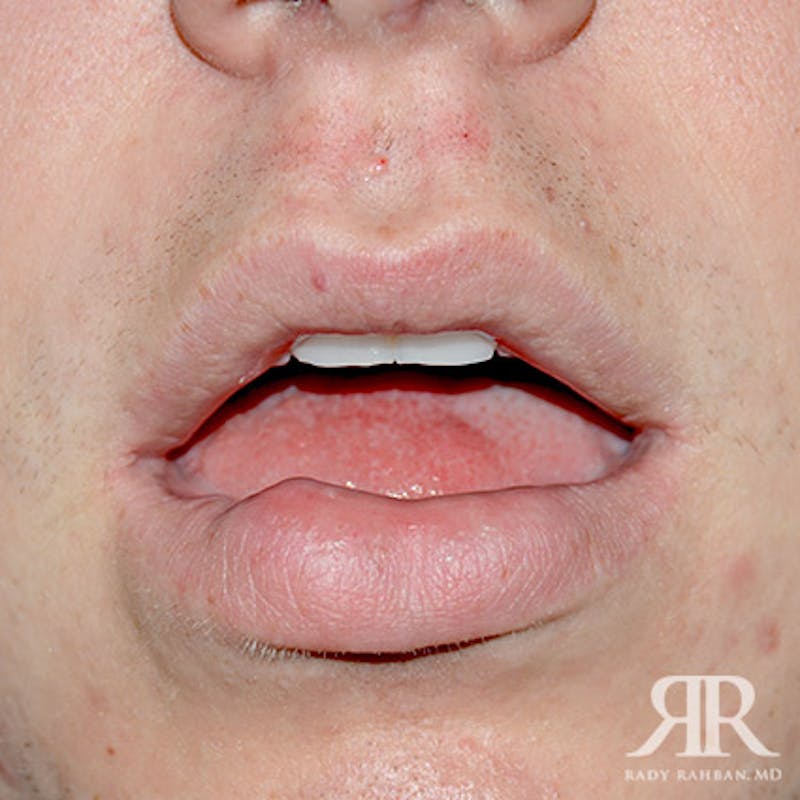 Lip Reduction / Lip Correction Before & After Gallery - Patient 784105 - Image 1
