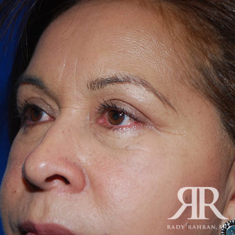 Browlift Before & After Gallery - Patient 296243 - Image 6