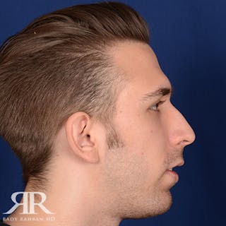 Chin Augmentation Before & After Gallery - Patient 361159 - Image 6