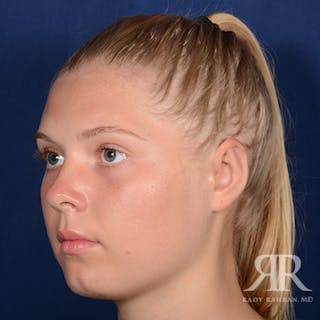 Ear Pinning Surgery Before & After Gallery - Patient 429091 - Image 4