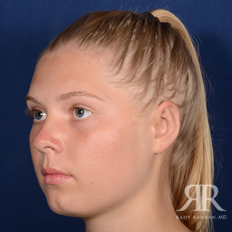 Ear Pinning Surgery Before & After Gallery - Patient 429091 - Image 4
