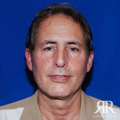 Facelift Before & After Gallery - Patient 216904 - Image 1