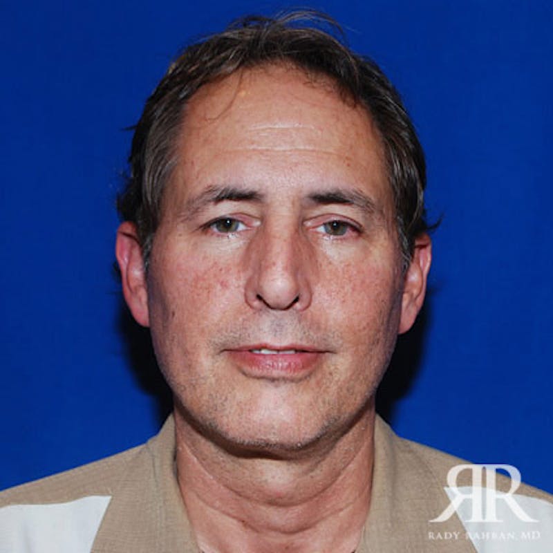 Facelift Before & After Gallery - Patient 216904 - Image 1