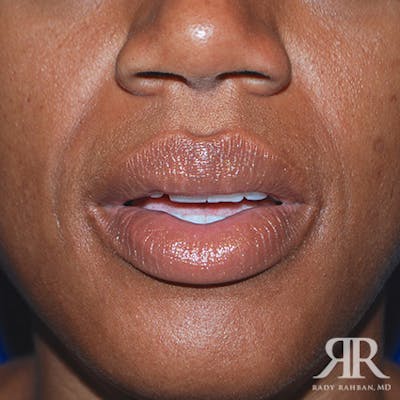 Lip Reduction / Lip Correction Before & After Gallery - Patient 260742 - Image 1