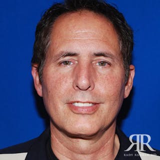 Facelift Before & After Gallery - Patient 216904 - Image 2