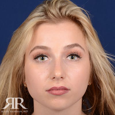 Chin Augmentation Before & After Gallery - Patient 411513 - Image 1