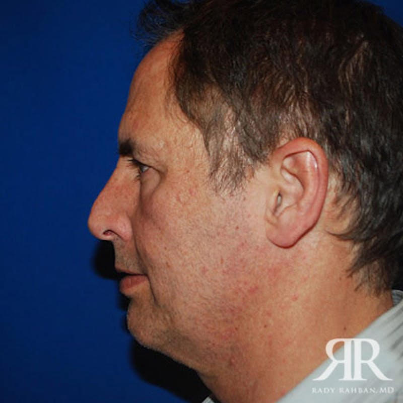 Facelift Before & After Gallery - Patient 216904 - Image 3