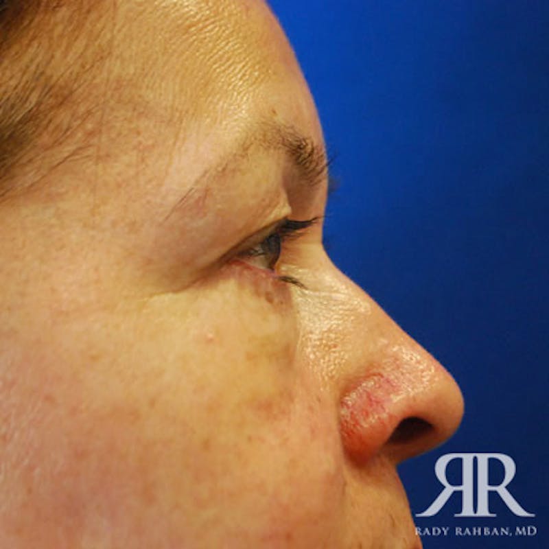 Eyelid Surgery Before & After Gallery - Patient 968496 - Image 3