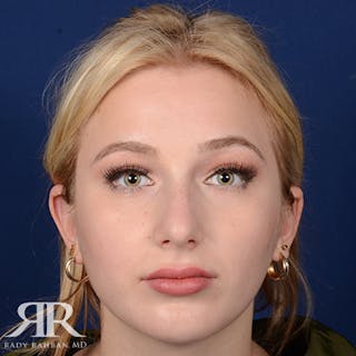 Chin Augmentation Before & After Gallery - Patient 411513 - Image 2