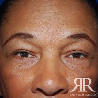 Browlift Before & After Gallery - Patient 346293 - Image 2