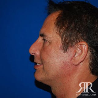 Facelift Before & After Gallery - Patient 216904 - Image 4