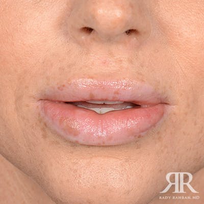 Lip Reduction / Lip Correction Before & After Gallery - Patient 110746 - Image 1