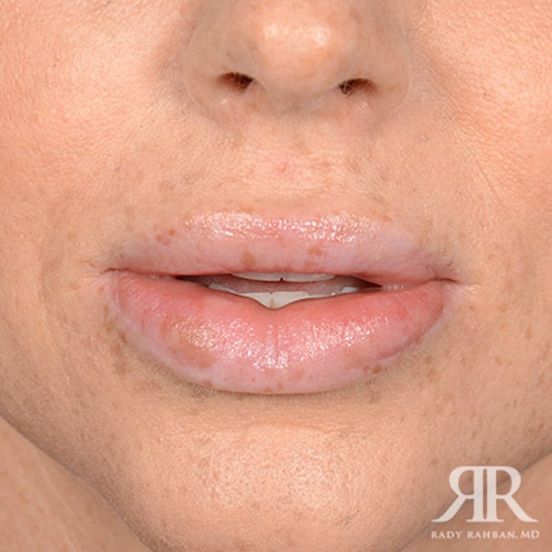 Lip Reduction / Lip Correction Before & After Gallery - Patient 110746 - Image 1