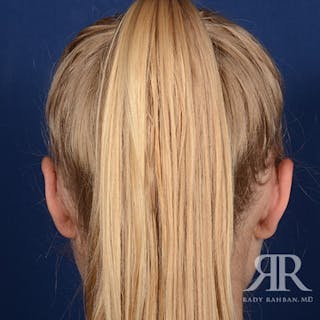 Ear Pinning Surgery Before & After Gallery - Patient 429091 - Image 8