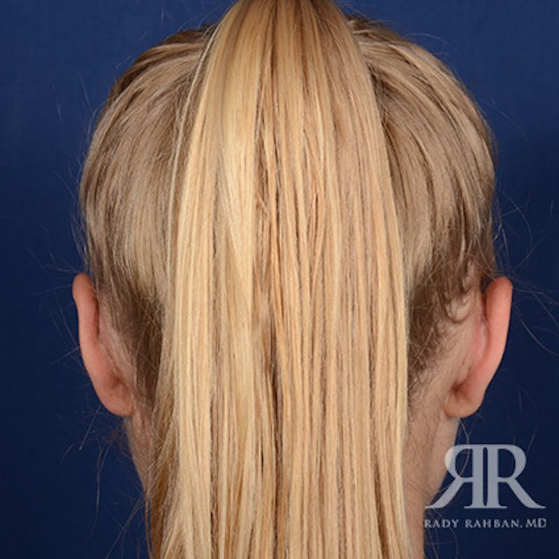 Ear Pinning Surgery Before & After Gallery - Patient 429091 - Image 8