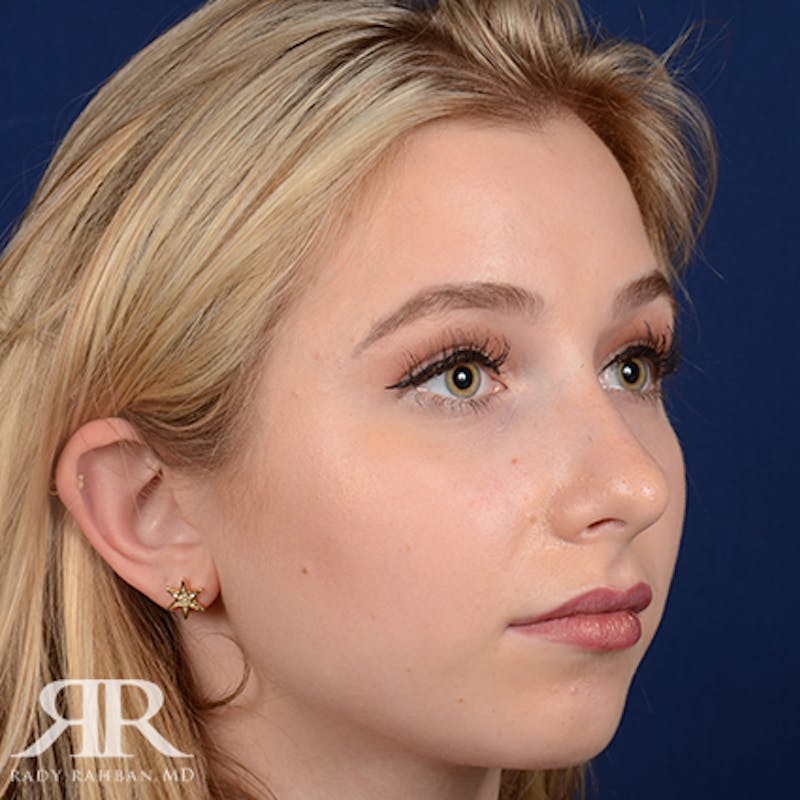 Chin Augmentation Before & After Gallery - Patient 411513 - Image 3