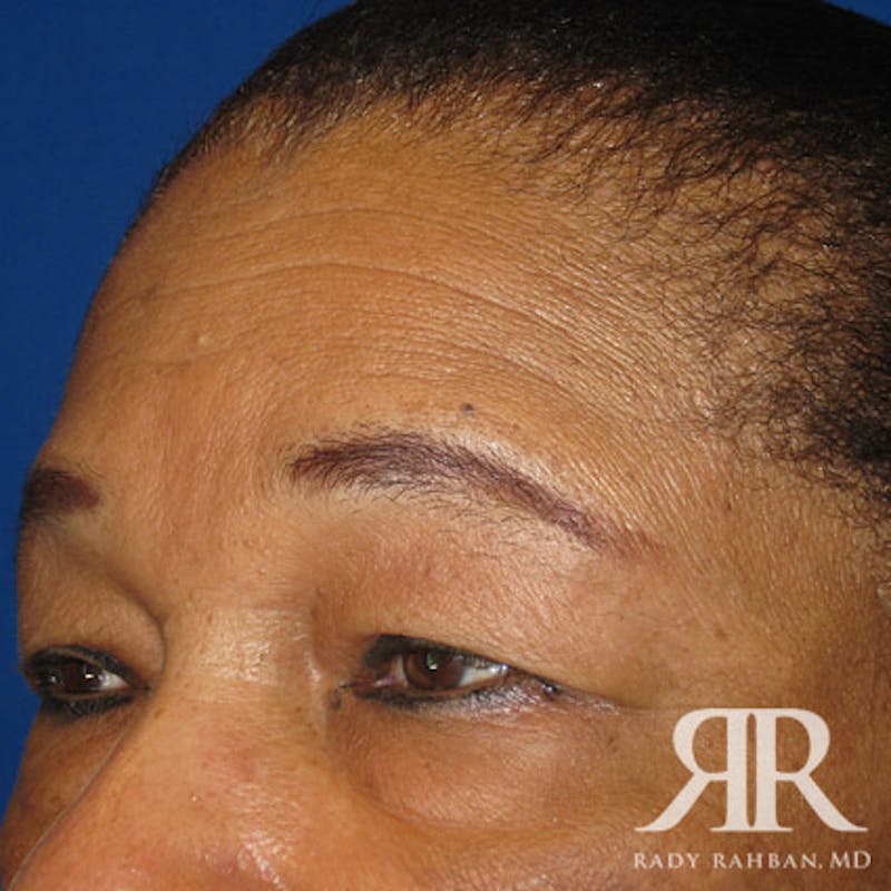 Browlift Before & After Gallery - Patient 346293 - Image 3