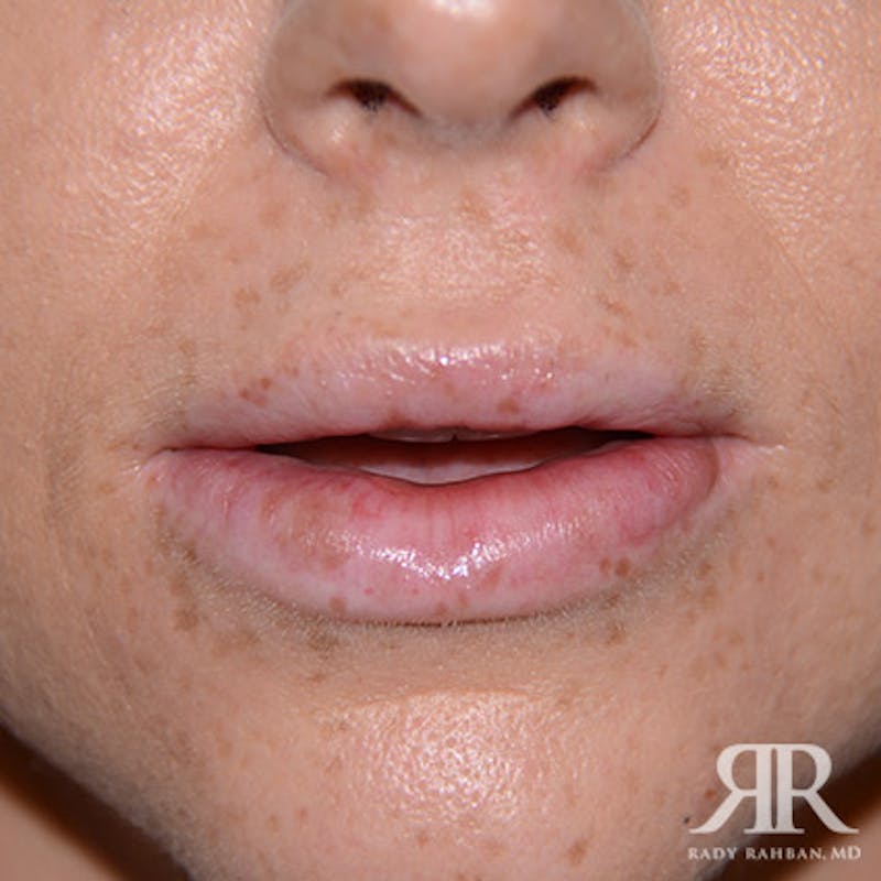 Lip Reduction / Lip Correction Before & After Gallery - Patient 110746 - Image 2