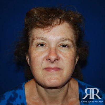 Facelift Before & After Gallery - Patient 111345 - Image 1