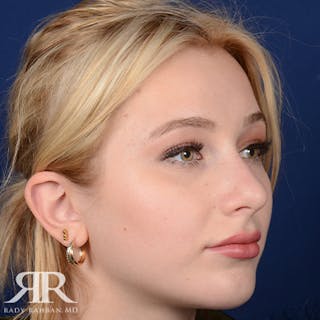 Chin Augmentation Before & After Gallery - Patient 411513 - Image 4