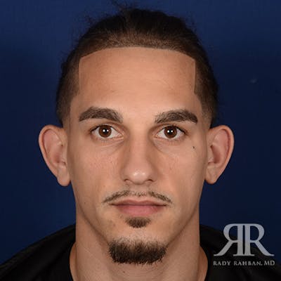 Ear Pinning Surgery Before & After Gallery - Patient 255708 - Image 1