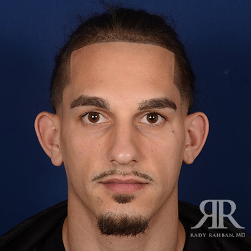 Ear Pinning Surgery Before & After Gallery - Patient 255708 - Image 1