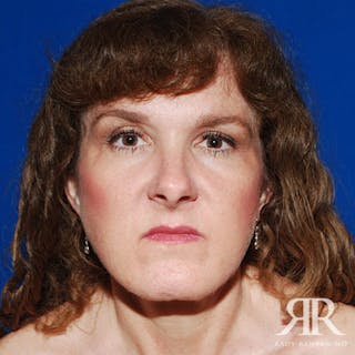 Facelift Before & After Gallery - Patient 111345 - Image 2