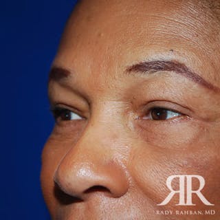 Browlift Before & After Gallery - Patient 346293 - Image 4