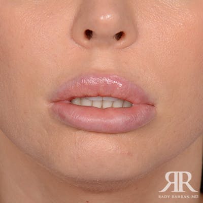 Lip Reduction / Lip Correction Before & After Gallery - Patient 748884 - Image 1