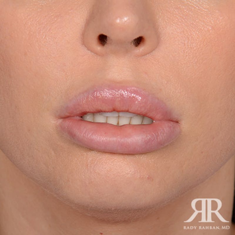 Lip Reduction / Lip Correction Before & After Gallery - Patient 748884 - Image 1
