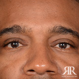 Eyelid Surgery Before & After Gallery - Patient 237243 - Image 2