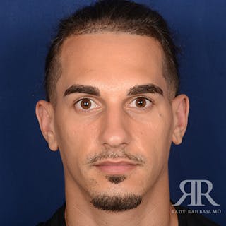 Ear Pinning Surgery Before & After Gallery - Patient 255708 - Image 2