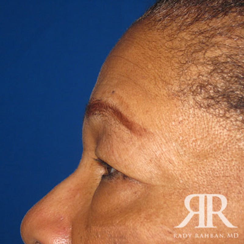 Browlift Before & After Gallery - Patient 346293 - Image 5