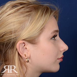 Chin Augmentation Before & After Gallery - Patient 411513 - Image 6