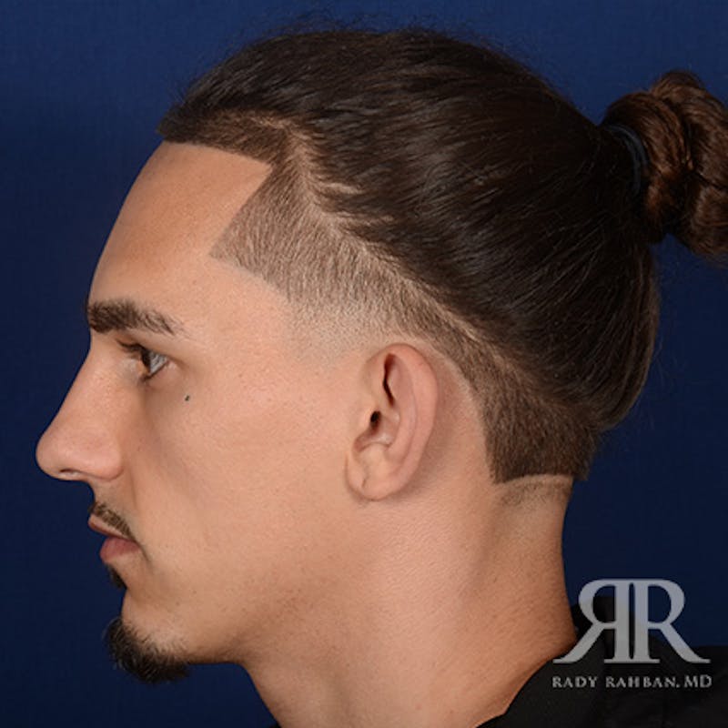 Ear Pinning Surgery Before & After Gallery - Patient 255708 - Image 3
